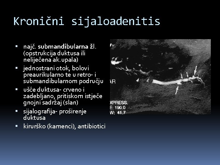 Kronični sijaloadenitis najč. submandibularna žl. žl (opstrukcija duktusa ili neliječena ak. upala) jednostrani otok,