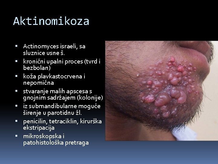 Aktinomikoza Actinomyces israeli, sa sluznice usne š. kronični upalni proces (tvrd i bezbolan) koža