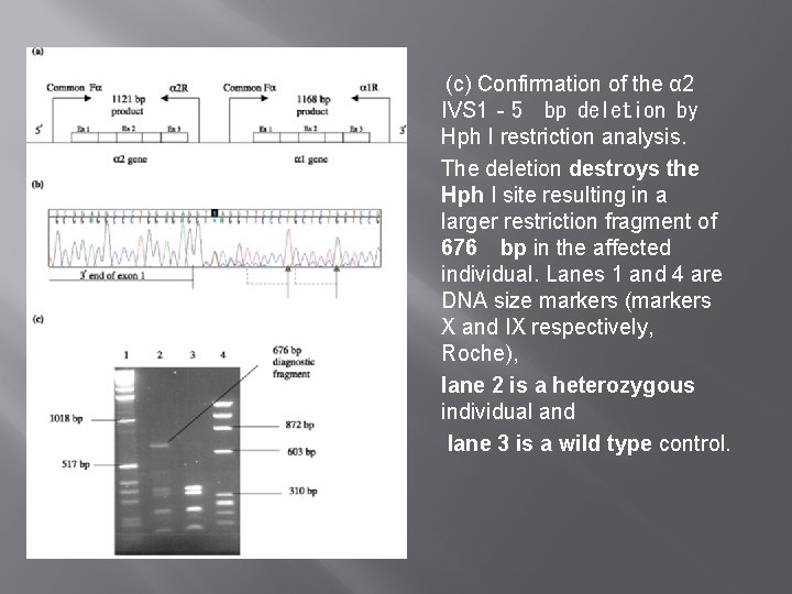  (c) Confirmation of the α 2 IVS 1‐ 5 bp deletion by Hph I