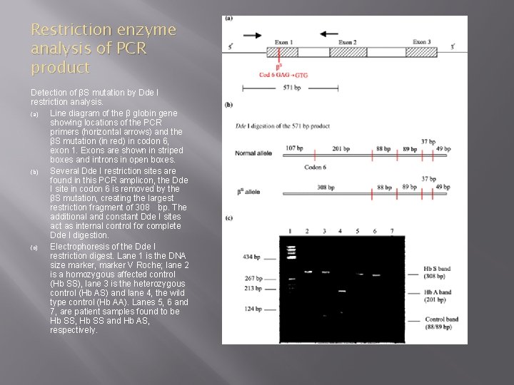 Restriction enzyme analysis of PCR product Detection of βS mutation by Dde I restriction