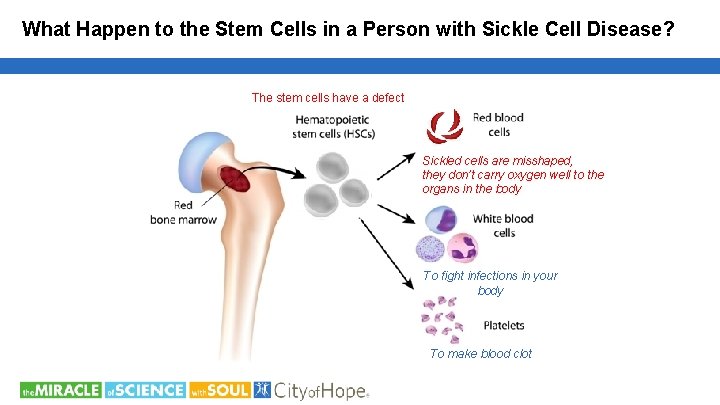 What Happen to the Stem Cells in a Person with Sickle Cell Disease? The