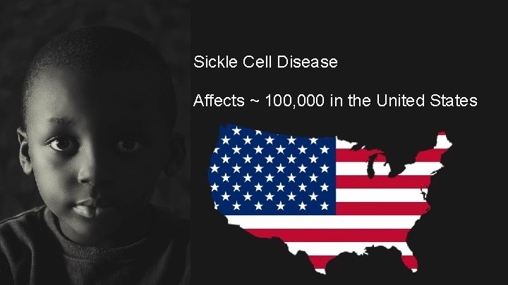 Sickle Cell Disease Affects ~ 100, 000 in the United States 