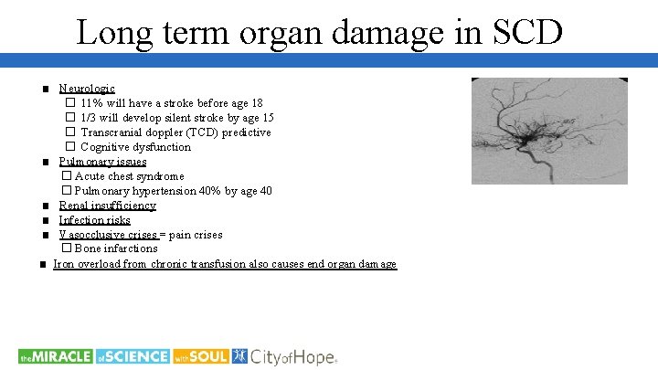Long term organ damage in SCD ■ Neurologic � 11% will have a stroke