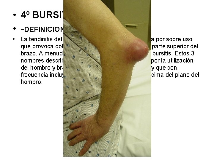  • 4º BURSITIS • -DEFINICION: • La tendinitis del manguito rotador es una