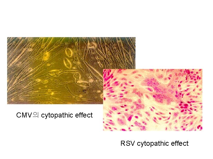 CMV의 cytopathic effect RSV cytopathic effect 