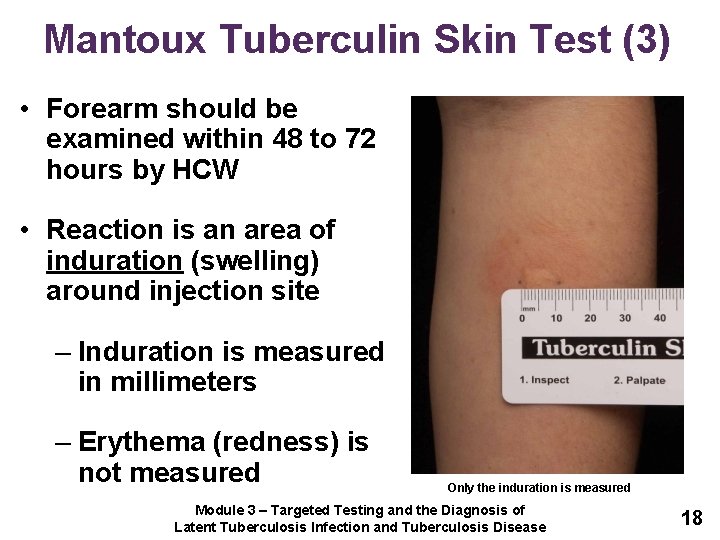 Mantoux Tuberculin Skin Test (3) • Forearm should be examined within 48 to 72