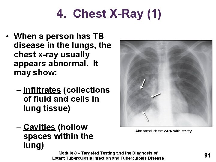 4. Chest X-Ray (1) • When a person has TB disease in the lungs,