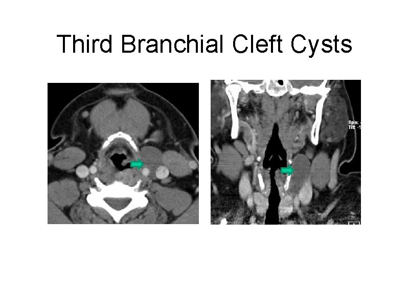Third Branchial Cleft Cysts 