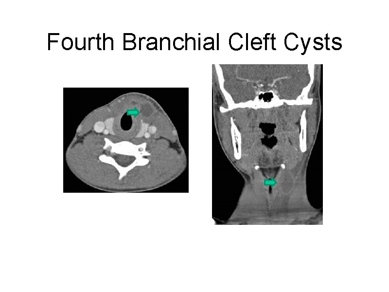 Fourth Branchial Cleft Cysts 