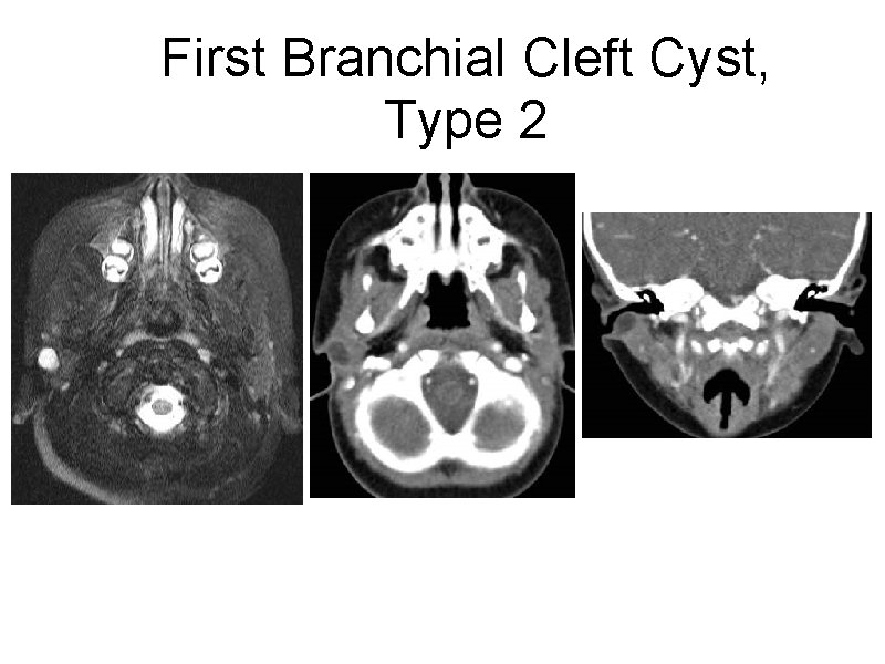 First Branchial Cleft Cyst, Type 2 