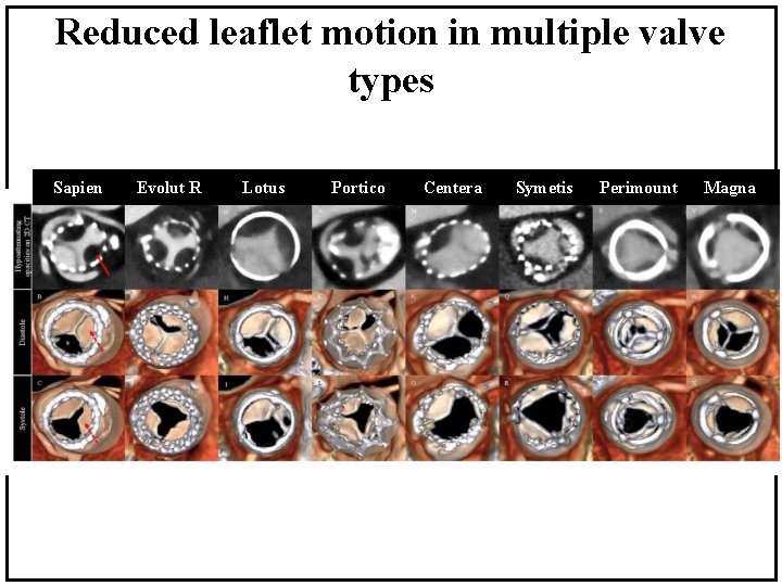 Reduced leaflet motion in multiple valve types Sapien Evolut R Lotus Portico Centera Symetis