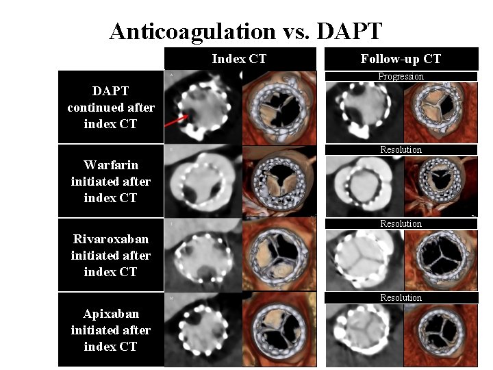 Anticoagulation vs. DAPT Index CT Follow-up CT Progression DAPT continued after index CT Resolution