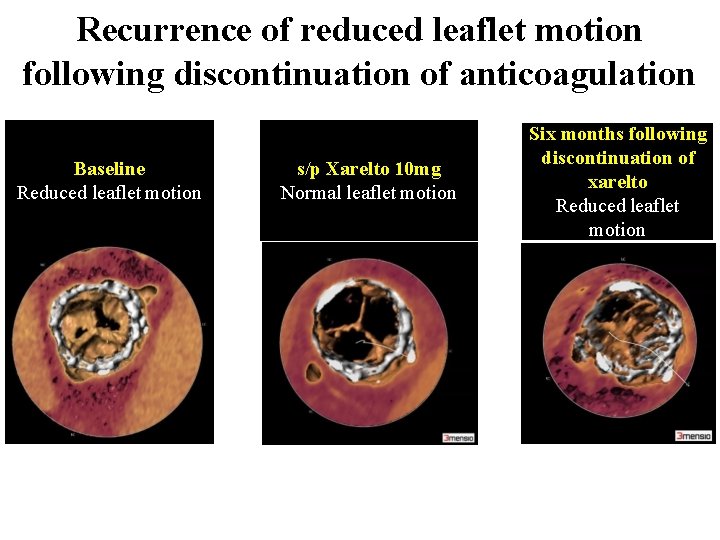 Recurrence of reduced leaflet motion following discontinuation of anticoagulation Baseline Reduced leaflet motion s/p