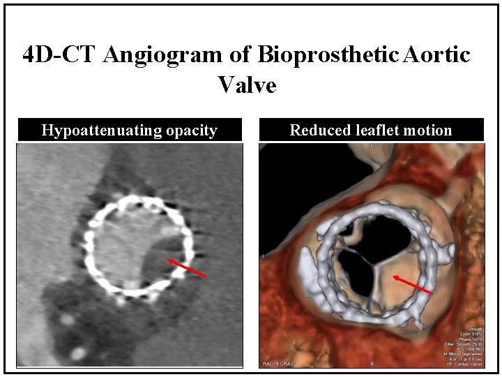 4 D-CT Angiogram of Bioprosthetic Aortic Valve Hypoattenuating opacity Reduced leaflet motion 