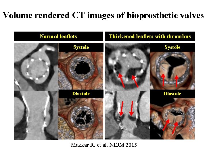 Volume rendered CT images of bioprosthetic valves Normal leaflets Thickened leaflets with thrombus Systole