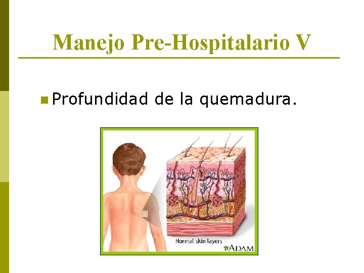 Manejo Pre-Hospitalario V n Profundidad de la quemadura. 