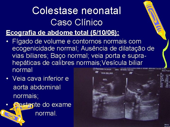 Colestase neonatal Caso Clínico Ecografia de abdome total (5/10/06): • Fígado de volume e