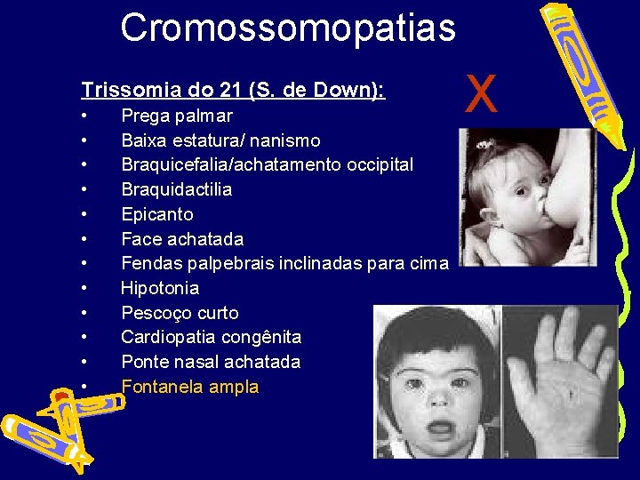 Cromossomopatias Trissomia do 21 (S. de Down): • • • Prega palmar Baixa estatura/