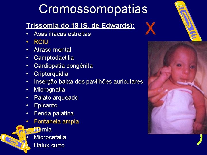 Cromossomopatias Trissomia do 18 (S. de Edwards): • • • • Asas ilíacas estreitas