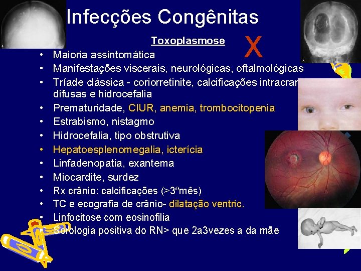 Infecções Congênitas • • • • X Toxoplasmose Maioria assintomática Manifestações viscerais, neurológicas, oftalmológicas