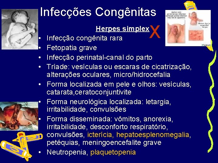 Infecções Congênitas • • X Herpes simplex Infecção congênita rara Fetopatia grave Infecção perinatal-canal