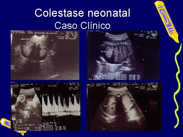 Colestase neonatal Caso Clínico 