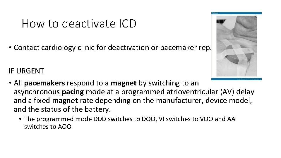 How to deactivate ICD • Contact cardiology clinic for deactivation or pacemaker rep. IF