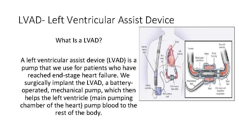 LVAD- Left Ventricular Assist Device What Is a LVAD? A left ventricular assist device