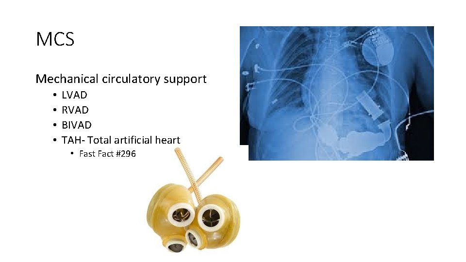 MCS Mechanical circulatory support • • LVAD RVAD BIVAD TAH- Total artificial heart •