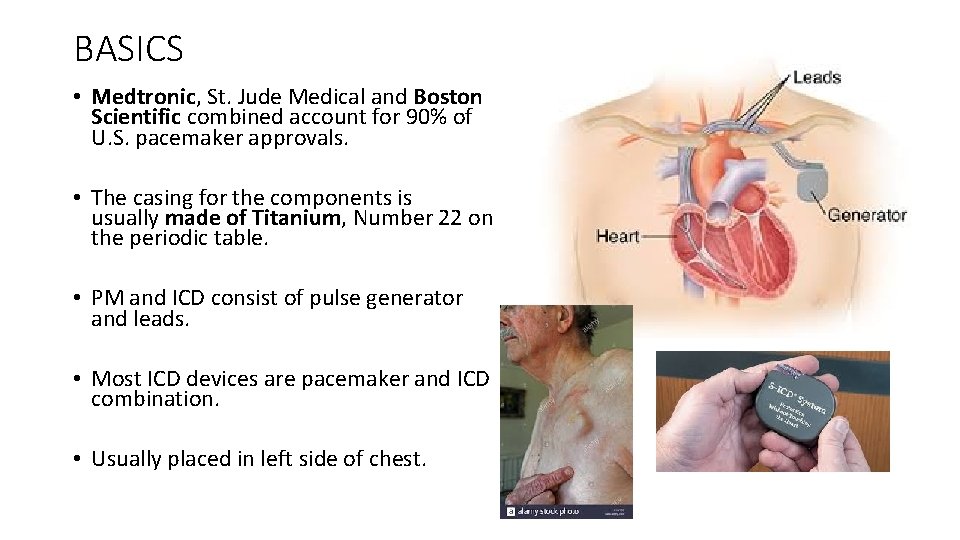 BASICS • Medtronic, St. Jude Medical and Boston Scientific combined account for 90% of