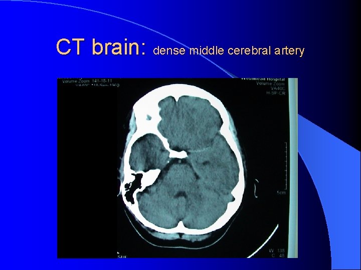 CT brain: dense middle cerebral artery 