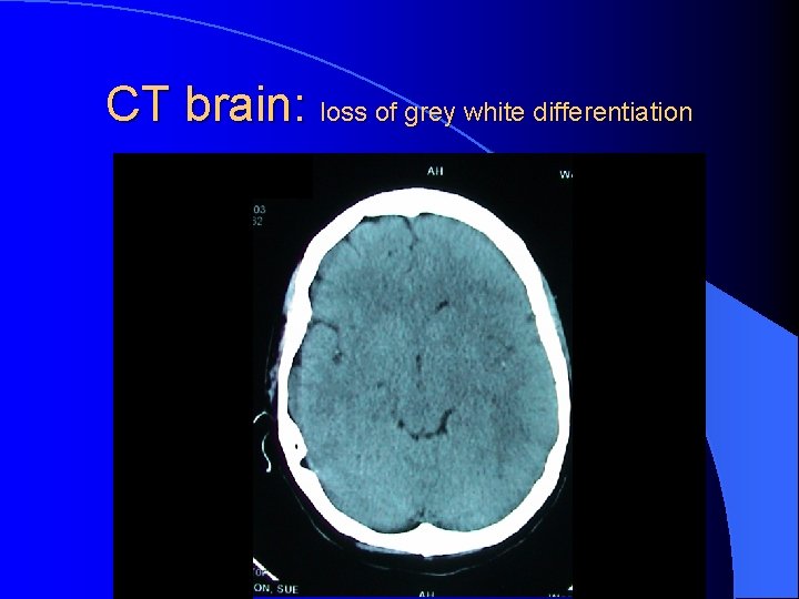 CT brain: loss of grey white differentiation 