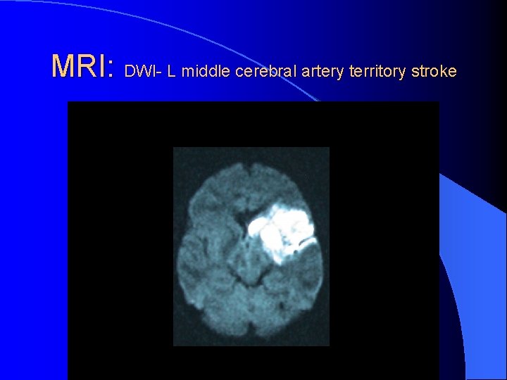 MRI: DWI- L middle cerebral artery territory stroke 