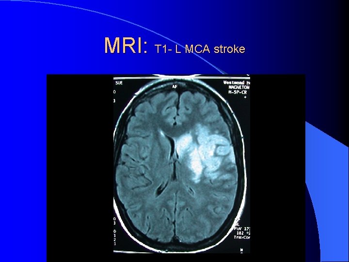MRI: T 1 - L MCA stroke 