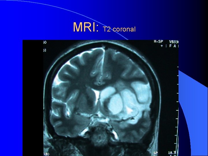 MRI: T 2 coronal 