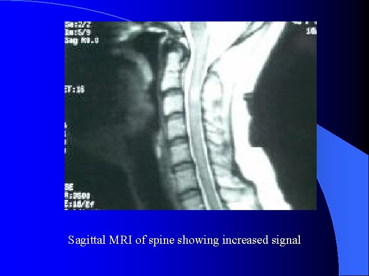 Sagittal MRI of spine showing increased signal 