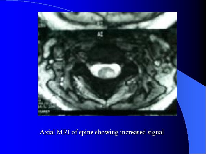Axial MRI of spine showing increased signal 