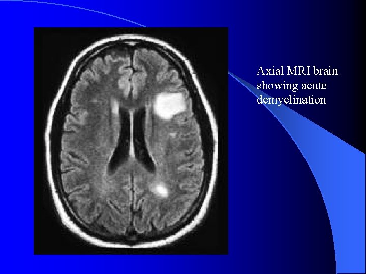 Axial MRI brain showing acute demyelination 