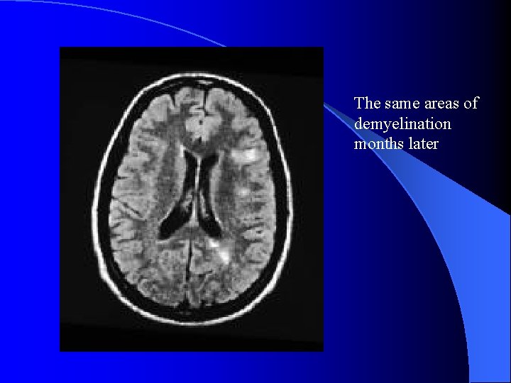 The same areas of demyelination months later 