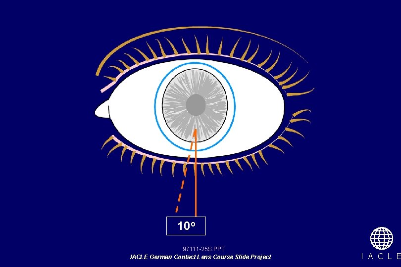 10 o 97111 -25 S. PPT IACLE German Contact Lens Course Slide Project I