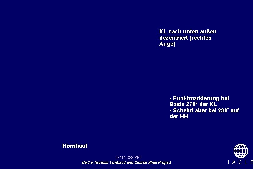 KL nach unten außen dezentriert (rechtes Auge) - Punktmarkierung bei Basis 270° der KL