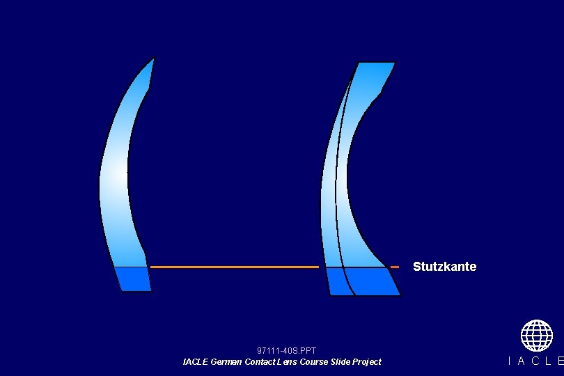 Stutzkante 97111 -40 S. PPT IACLE German Contact Lens Course Slide Project I A