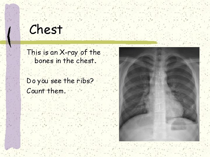 Chest This is an X-ray of the bones in the chest. Do you see