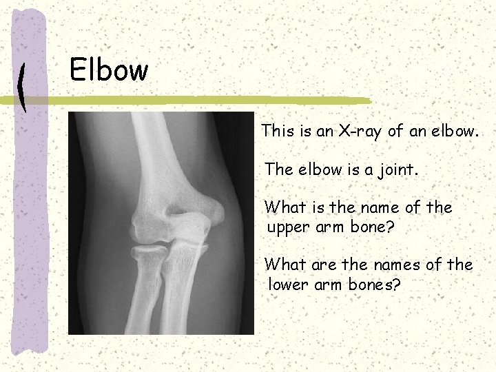 Elbow This is an X-ray of an elbow. The elbow is a joint. What