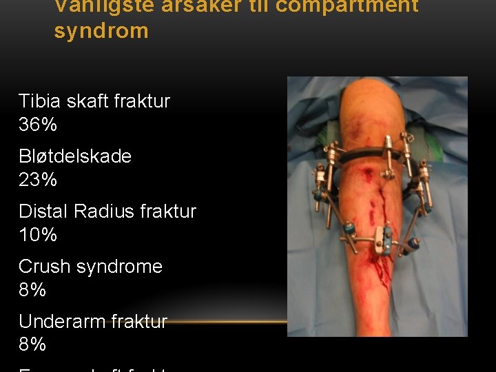 Vanligste årsaker til compartment syndrom Tibia skaft fraktur 36% Bløtdelskade 23% Distal Radius fraktur