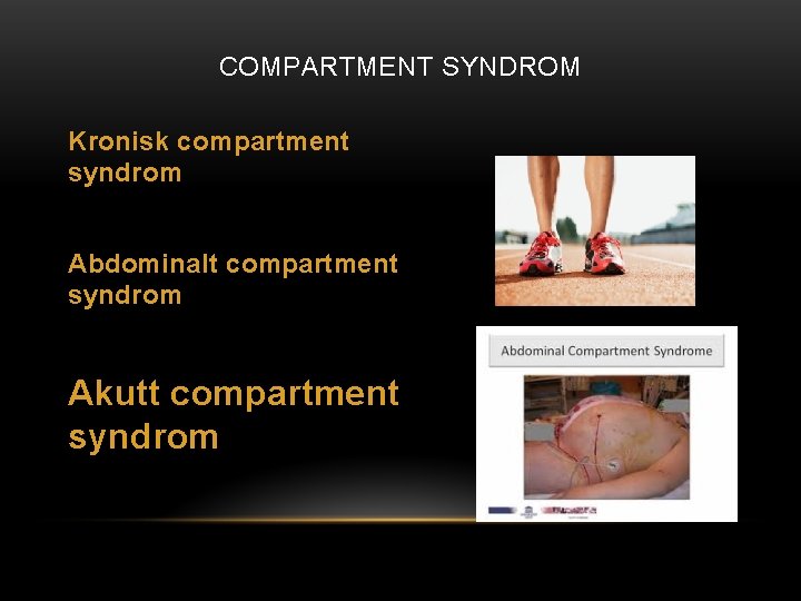 COMPARTMENT SYNDROM Kronisk compartment syndrom Abdominalt compartment syndrom Akutt compartment syndrom 