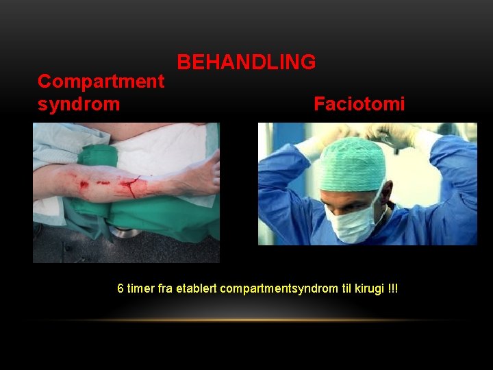 Compartment syndrom BEHANDLING Faciotomi 6 timer fra etablert compartmentsyndrom til kirugi !!! 