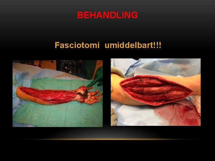 BEHANDLING Fasciotomi umiddelbart!!! 