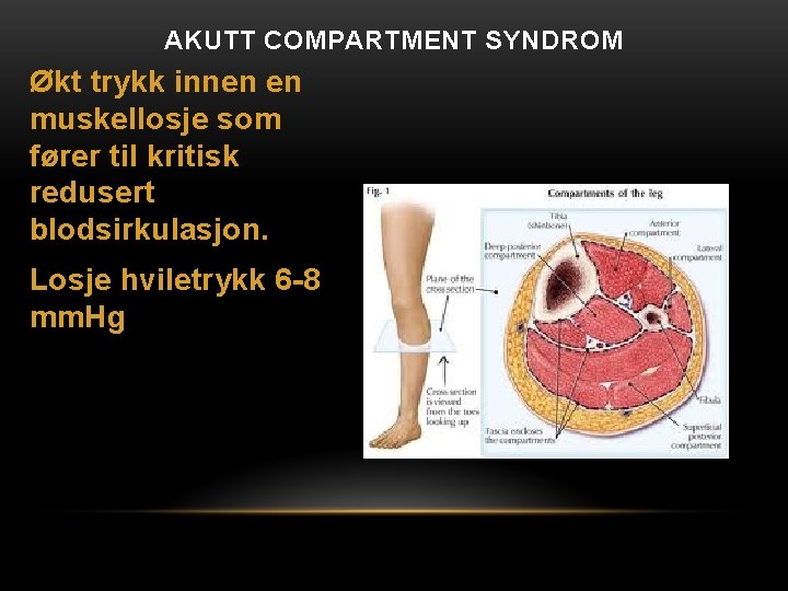 AKUTT COMPARTMENT SYNDROM Økt trykk innen en muskellosje som fører til kritisk redusert blodsirkulasjon.