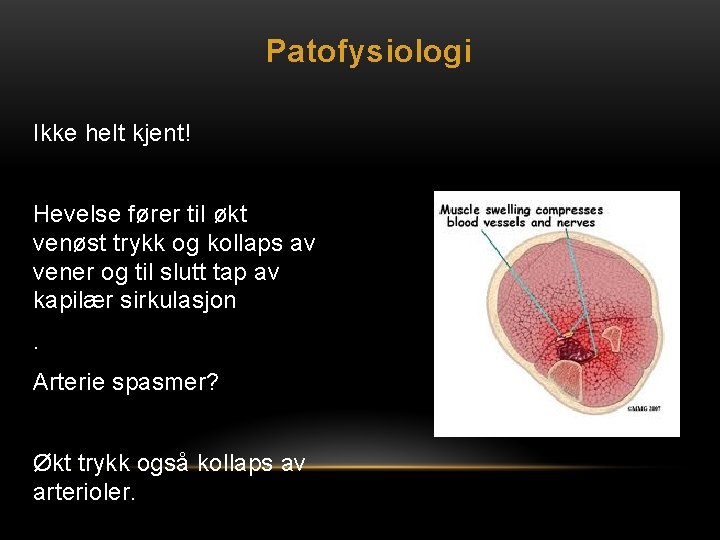 Patofysiologi Ikke helt kjent! Hevelse fører til økt venøst trykk og kollaps av vener